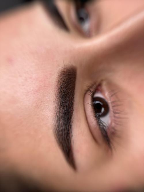 Eyebrow Tattoo Laser Removal NYC