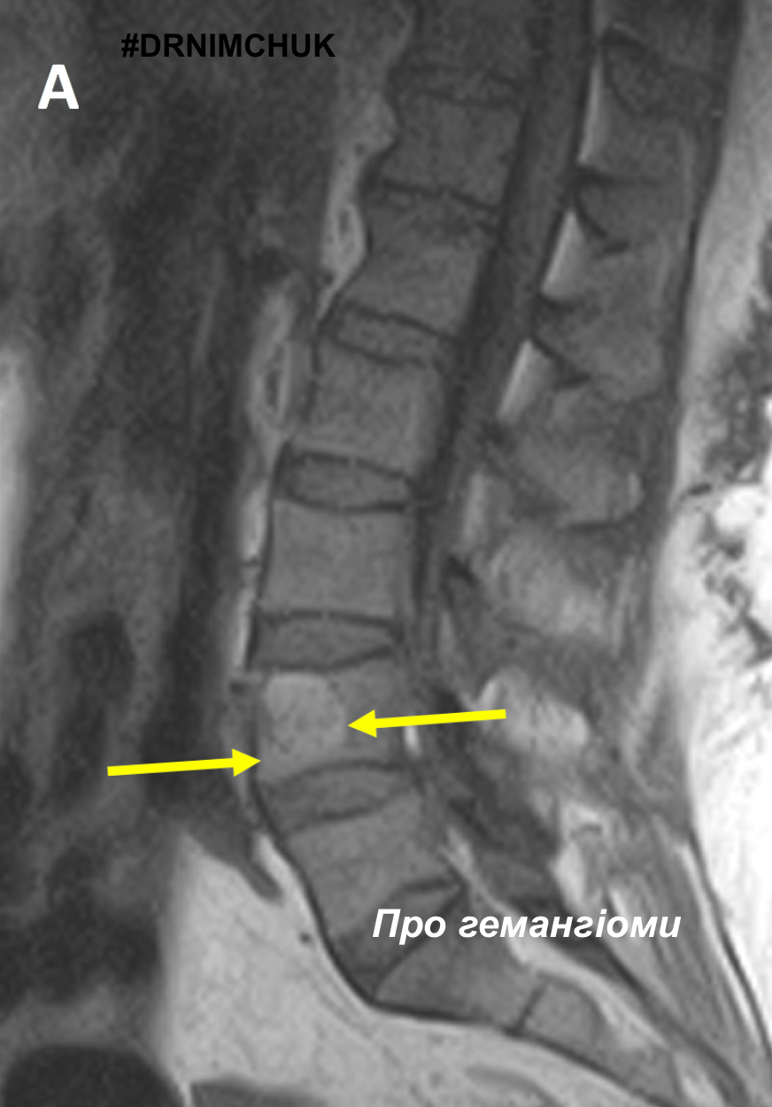 Гемангиома позвонка на кт. Гемангиолипома и гемангиома. Гемангиома позвонка на мрт. Гемангиомы l2 l4 позвонков. Гемангиолипомы что это такое гемангиолипома позвоночника.